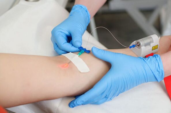 tratamento con láser intravenoso para a psoríase nas pernas