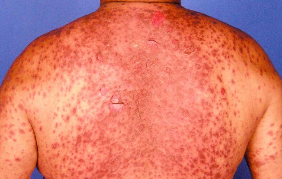 eritrodermia psoriásica nas costas