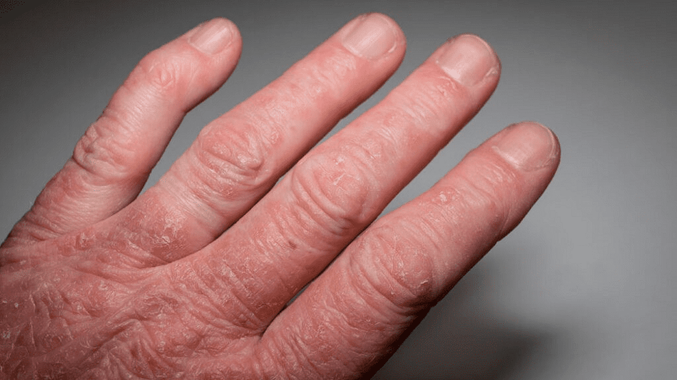 artrite psoriásica nas mans