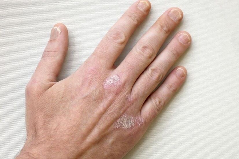 Un síntoma obrigatorio da psoríase son as placas con escamas na pel