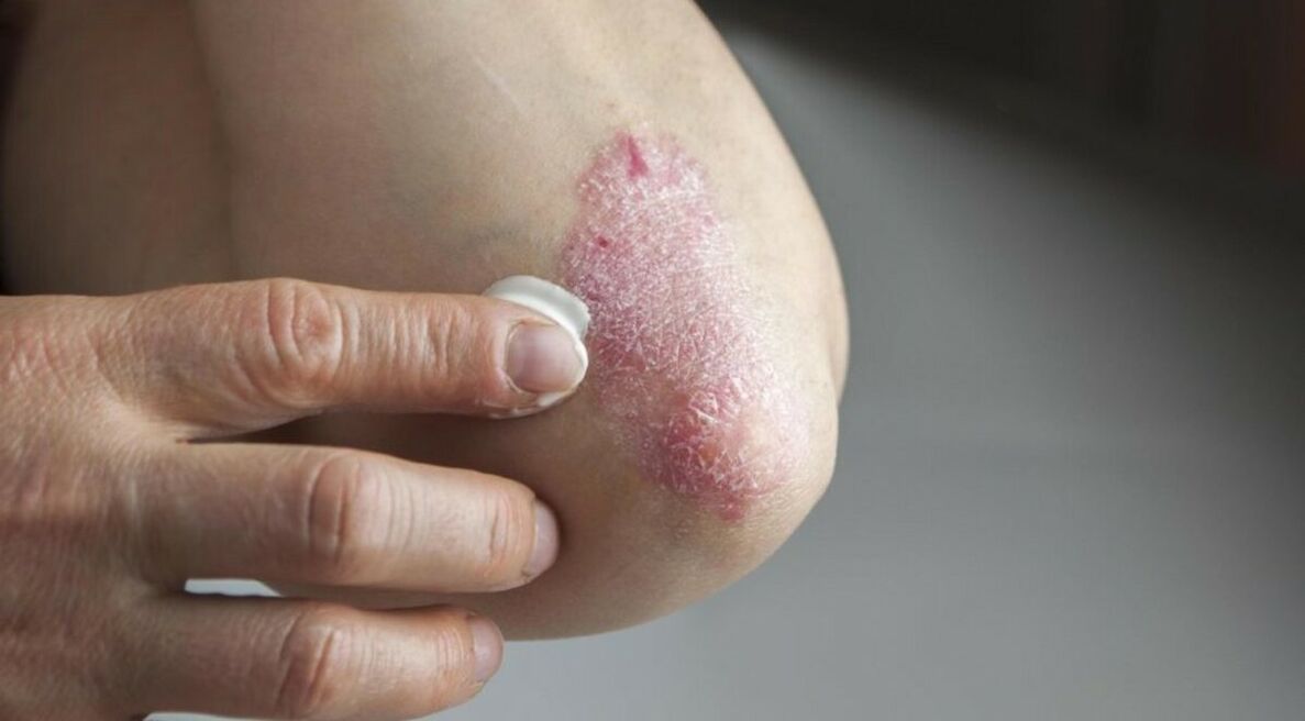 Psoríase que afecta a pel, cuxo tratamento inclúe o uso de pomadas
