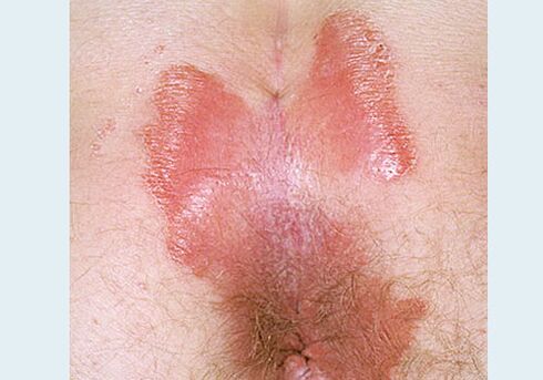 PREGACIÓN PSORIASIS SPINNING