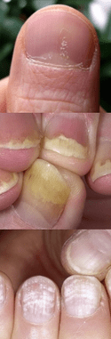 Psoríase das uñas - fase inicial