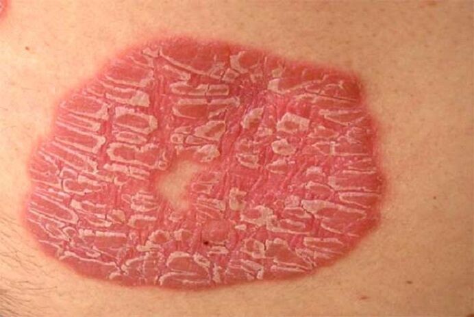 psoríase pustulosa