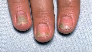 causas de psoríase nas uñas